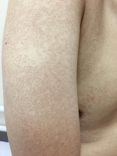 Folikulinė keratozė žąsies oda Dermatologo konsultacija internetu