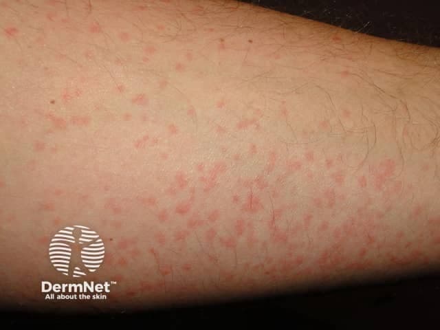 Рассеянные красные пятна и волдыри на предплечье, характерные для холодовой крапивницы.