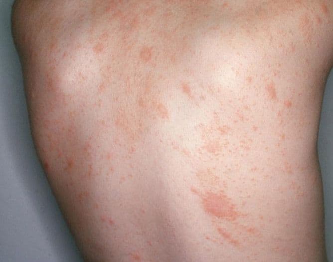Розовый лишай (Pityriasis rosea): сыпь из розовых шелушащихся пятен на спине и боку.