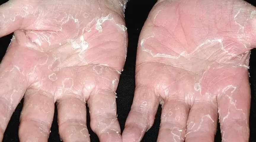Обе ладони с синдромом шелушащейся кожи: кожа сходит крупными пластами, обнажая покрасневшую кожу.