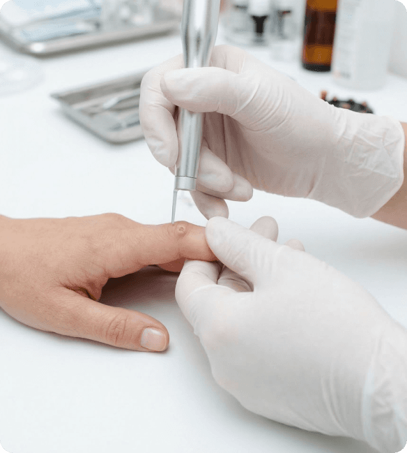 A bright, close-up photograph of a targeted dermatological tool being used by a practitioner to treat or remove a small, localized skin lesion on a patient's skin surface