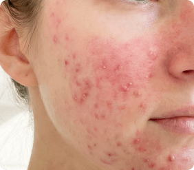 title.papulopustular.form