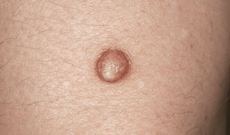 Mažas dermatofibromos papulė Mažas kupolo formos rusvas dermatofibromos darinys ant odos – nepiktybinis ir kietas mazgelis.