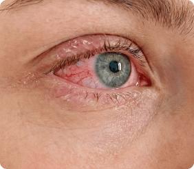 Очень крупный план воспаленного, налитого кровью глаза. title.ophthalmic.form