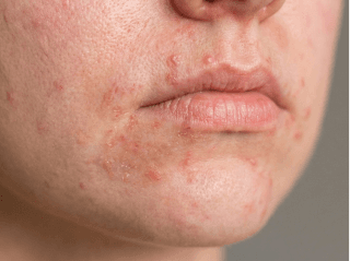 Perioralinio dermatito dėmės aplink burną ir smakrą iš arti /images/dermatitis/trail-10.png