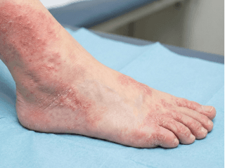 Iš arti matomas vietinis odos lupimasis ir pleiskanojimas ant piršto /images/dermatitis/trail-11.png