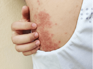Iš arti mažų, šiurkščių iškilimų rankos gale /images/dermatitis/trail-12.png
