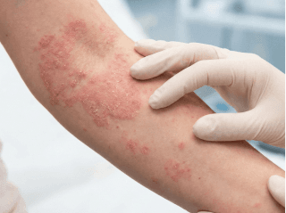 Medicinos specialistas apžiūri iškilusį, žvynuotą bėrimą ant rankos /images/dermatitis/trail-7.png