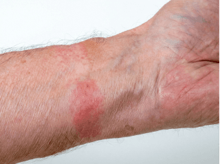 Lokalus raudonas, apskritas odos pažeidimas ant riešo /images/dermatitis/trail-8.png