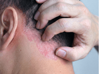 Asmuo skelia plaukus, kad apatinėje galvos odos dalyje atsirastų uždegimo apnašos /images/dermatitis/trail-9.png