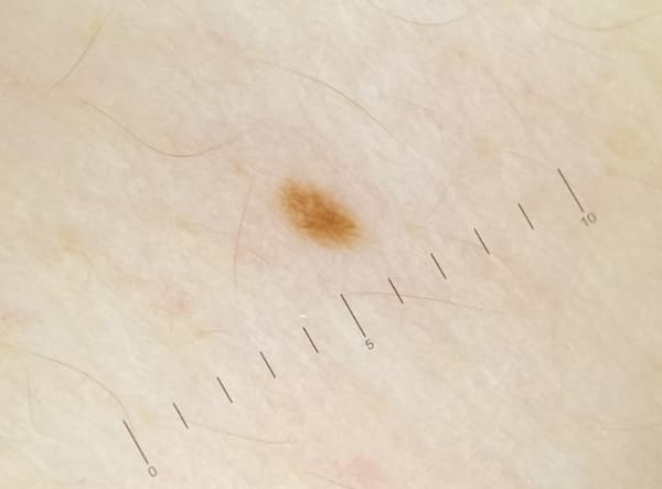 Didelio padidinimo dermoskopinis odos apgamo vaizdas. Labai padidintas apskritas pigmentinio odos pažeidimo dermoskopinis vaizdas, kuriame matomos smulkios pigmentų tinklo struktūros, kurias dermatologai naudoja diagnostikai.
