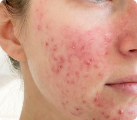 title.papulopustular.form