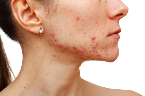 Adult Acne