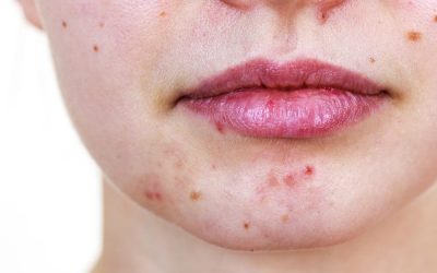 Adult acne. Is acne just a teenage disease?