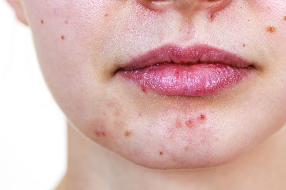 Adult acne - is acne just a teenage disease