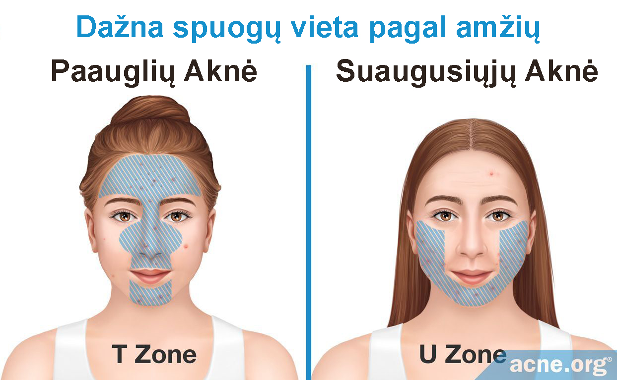 Adult vs Teenage Acne