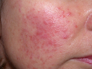 Facial rosacea dermatology