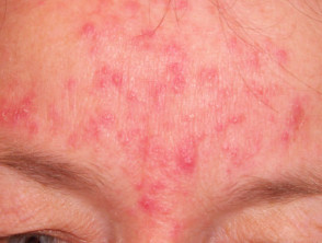 Veido rožinė odos liga