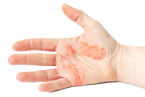 Kontaktinis dermatitas rankos