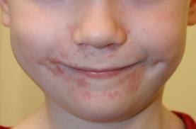 Perioral dermatitis skin disease in a child