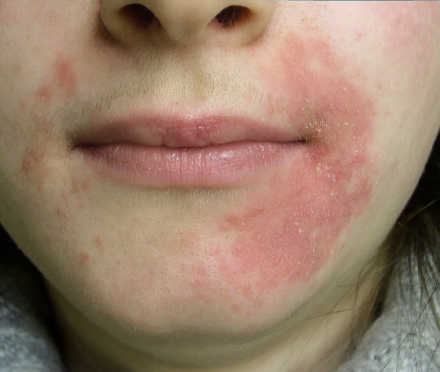 Perioral dermatitis skin disease