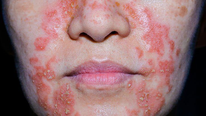 Perioralinis dermatitas odos ligas odos gydytojas