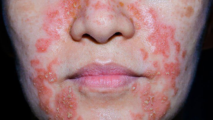 Perioral dermatitis