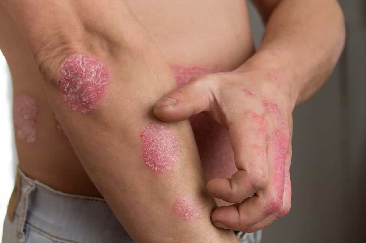 Psoriasis - Skin disease Dermatologist Help