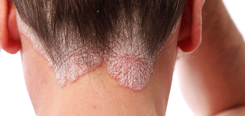 Psoriasis Skin disease