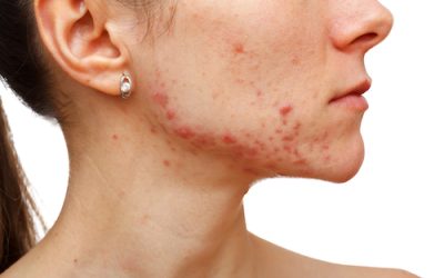 Acne, what is it?