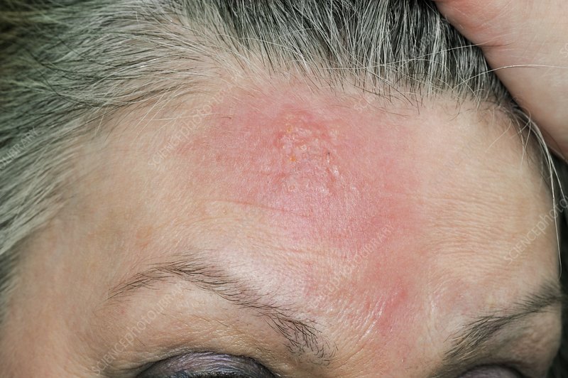 Striped half-blanket on forehead