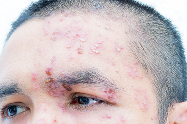 Shingles on the face