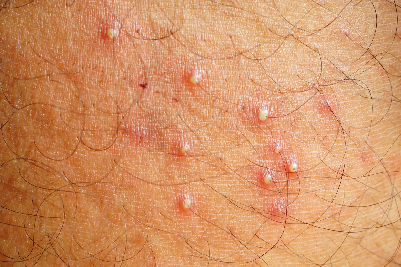 ingrown hair vs herpes