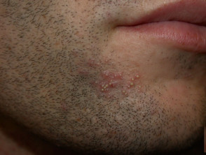 Folliculitis Skin Diseases 4