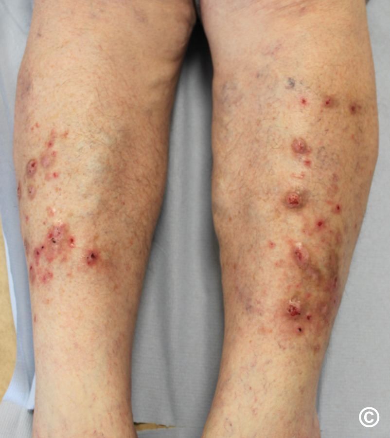 Prurigo nodularis legs