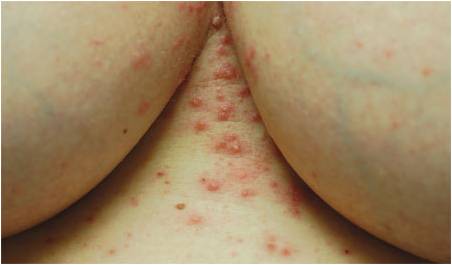 Pruritic Nodules on the Breast