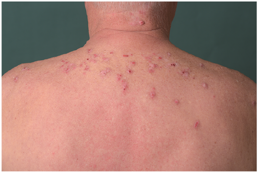 Prurigo nodularis back skin disease