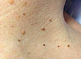 Aknė, kas tai - odos liga - nugaros nuotraukos