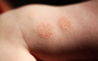 Nummular Eczema