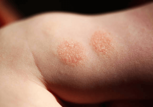 Numulinis Monetiskasis dermatitas odos liga vaikas