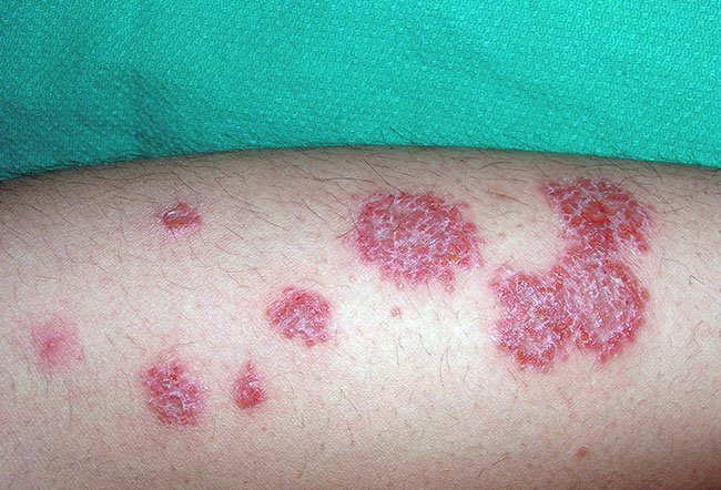 Numulinis Monetiskasis dermatitas odos liga