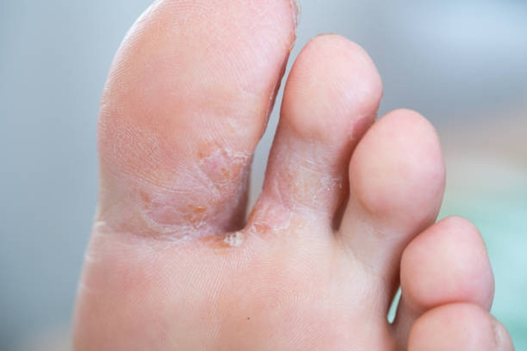 Pėdų grybelis Odos liga Dermatologija