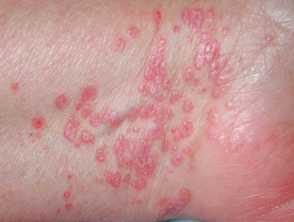 Acne, what is it - a skin disease - photos