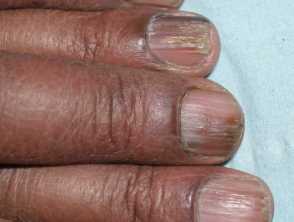 Flat lichen planus nails