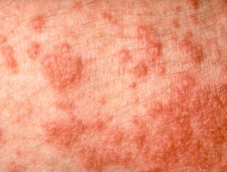 Polymorphic light rash (sun allergy) 2