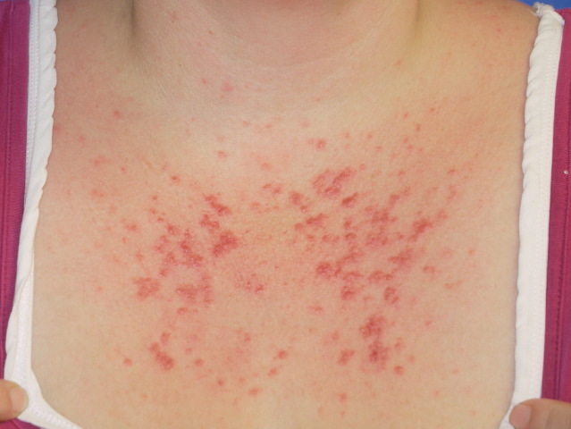 Acne, what is it - a skin disease - photos