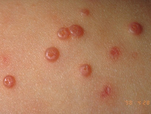 Infectious mollusc Skin disease 4