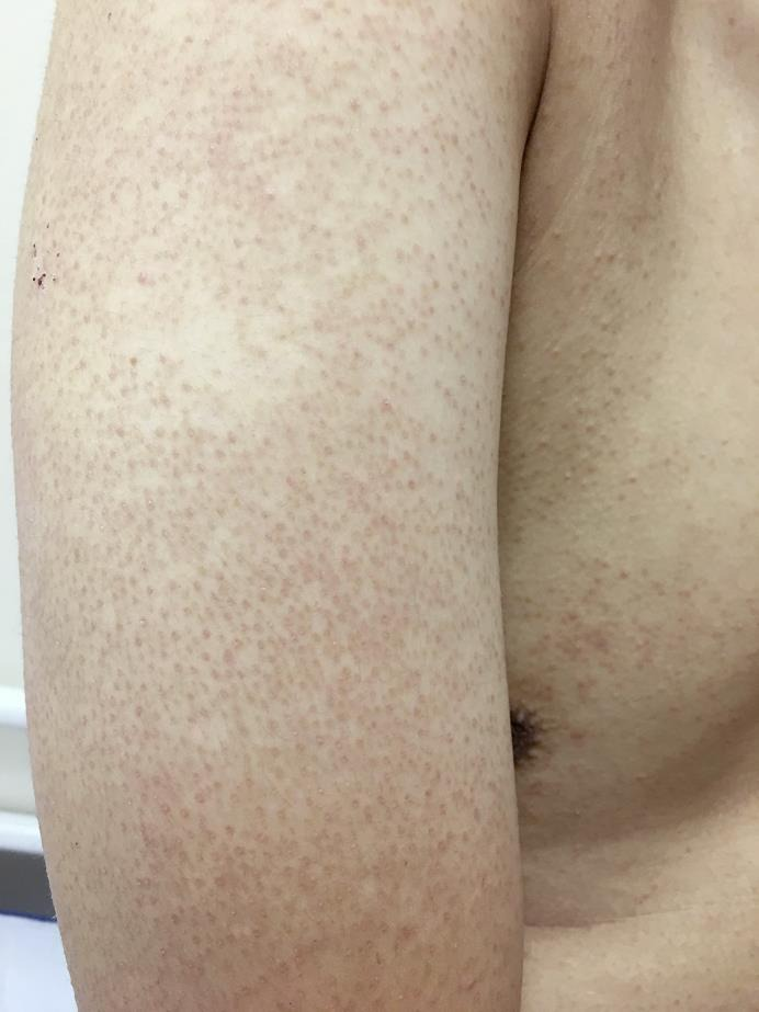 keratosis pilaris - goosebumps, skin disease