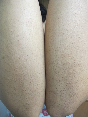 keratosis pilaris - goosebumps