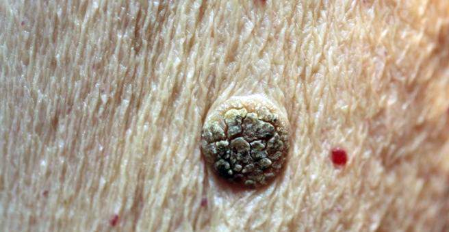 seborrhoeic keratosis